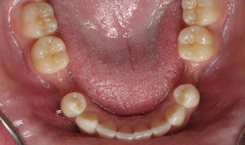 Mơ Thấy Gãy Răng Đánh Số Gì? Cơ Hội Trúng Đề Từ Giấc Mơ 2 Gãy răng hàm dưới