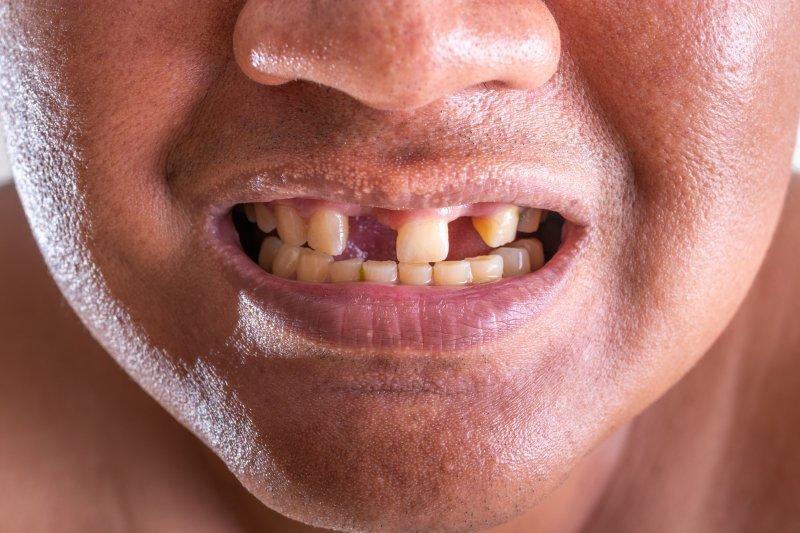 Nằm Mơ Thấy Rụng Răng Đánh Số Gì? Con Số “Vàng” Theo Dân Gian 2 Mơ thấy rụng răng đánh con gì để gặp may?