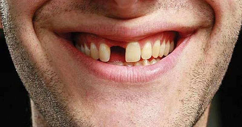 Nằm Mơ Thấy Rụng Răng Đánh Số Gì? Con Số “Vàng” Theo Dân Gian 3 Vì sao giấc mơ rụng răng lại phổ biến đến vậy?
